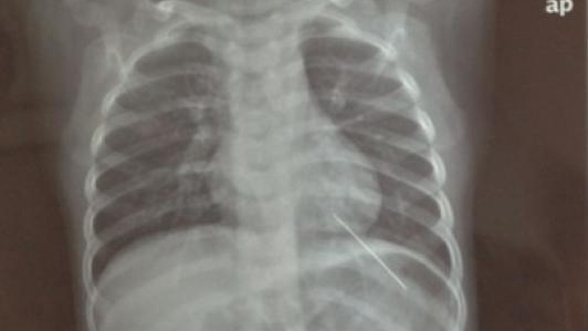 南京1岁男婴被绣花针刺穿肺部 已报案